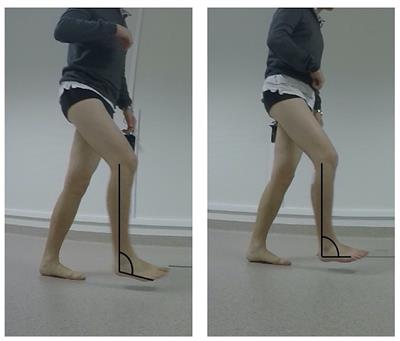 Respective Contributions of Instrumented 3D Gait Analysis Data and Tibial Motor Nerve Block on Presurgical Spastic Equinus Foot Assessment: A Retrospective Study of 40 Adults